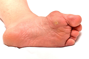 bunions on heels of feet