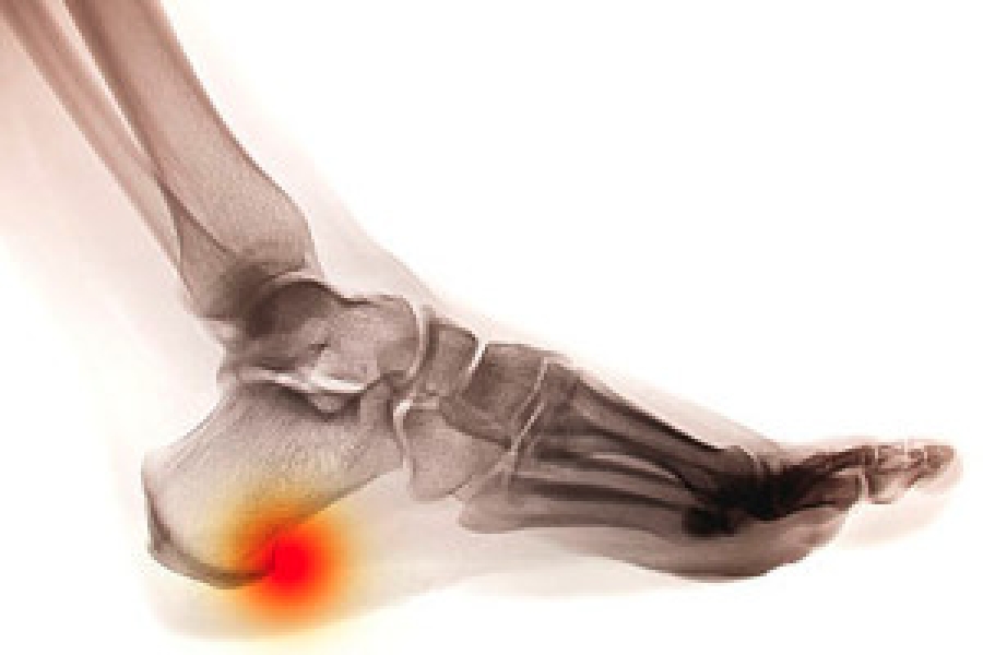 Heel pain hot sale bone growth