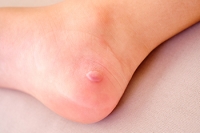 Caring for Blisters on the Foot