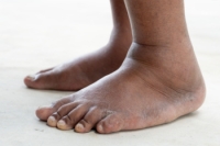 Managing Swollen Feet